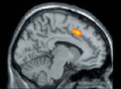 Anterior Cingulate Cortex